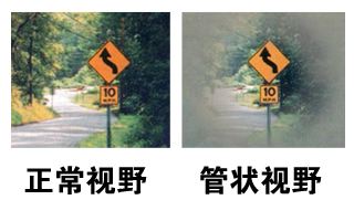 當(dāng)青光眼遇上白內(nèi)障，這場防盲保衛(wèi)戰(zhàn)該怎么打？